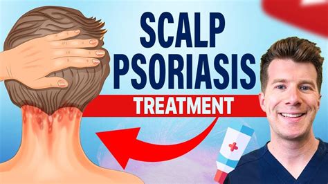 Treating scalp psoriasis - Overview | Guy's and St … - balustradellc