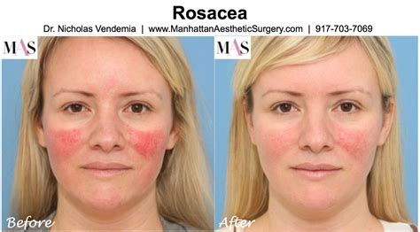 Treatments for Rosacea | U.S. News - balustradellc