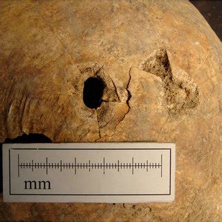Trepanation in archaic human remains - Springer - wintechmobiles.com
