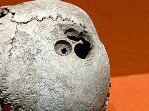 Trepanation in Mesoamerica - wintechmobiles.com