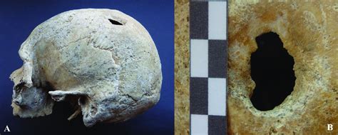 Trepanned cranium - The Lancet - wintechmobiles.com