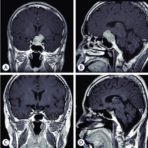 TSH-Secreting Pituitary Adenomas (Thyrotropinomas)