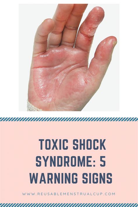 TSS: 5 Warnings Signs How do I Know if I Have Toxic Shock …