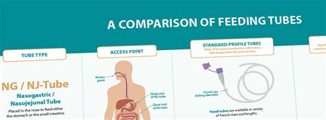 Tube Feeding (Enteral Nutrition): How It Works, Types, Placement - balustradellc
