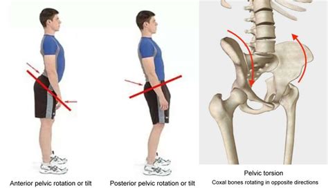 Twisted Pelvis Self Correction: How to Fix Pelvic Tilt - balustradellc