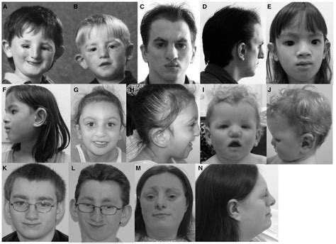 TXNL4A-Related Craniofacial Disorders - Abstract - Europe PMC