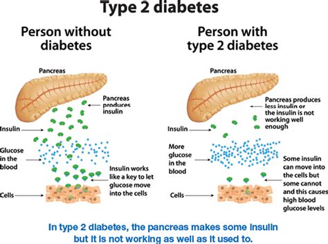Type 2 diabetes - Symptoms and causes - Mayo Clinic - muktibox.com