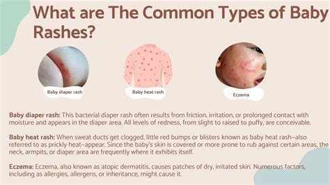 Types of Baby Rash & How to Treat & Prevent Them: Your New Mom … - balustradellc