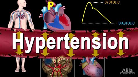 Taking the "tension" out of Hypertension - YouTube