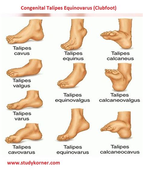 Talipes Equinovarus (Clubfoot) Consultant360