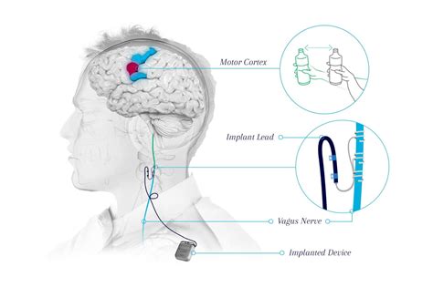 Targeted Vagus Nerve Stimulation for Rehabilitation After …