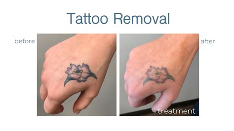Tattoo removals near me. Ink On Ink off in Cleveland, OH merges new tattoo artistry and tattoo removal introducing a new concept of tattoo alterations . Featuring state of the art PicoSure laser, we are removing tattoos in fewer treatments with better results! IOIO also proudly leads Cleveland in tattooing. We have award winning permanent makeup … 