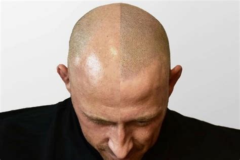  A hairline tattoo is a form of cosmetic tattooing – a type of tattoo done on the forehead, temples and scalp to recreate the look of hair. It can camouflage hair loss very successfully, and it works for many balding patterns, including the receding hairline. These treatments are not like traditional, body art tattooing, though. . 