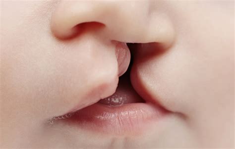 Tavşan dudak bebek.