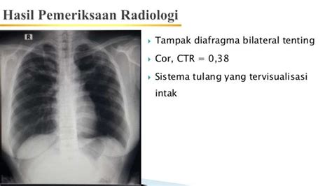 Tb Paru Lama Aktif Artinya - Academiskil