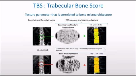 Tbs scans. Improve Identification of Patients’ Fracture Risk with TBS. FAST: no additional scan time, immediate results . SAFE: no additional radiation to patients. TBS derived from routine DXA exams EASY: automatic TBS report with BMD, TBS, FRAX adjusted for TBS . DIFFERENTIATES DXA. clinics and can increase patient referrals. Clinical Validation 