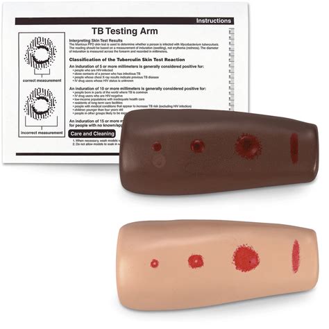 TB Skin Testing Results. If you have a raised, hard bump or there's swelling on your arm, you have a positive test. That means TB germs are in your body. But it doesn't always mean you have active .... 