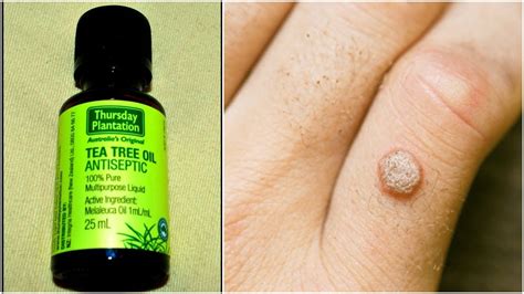 Tea Tree Oil for Warts and Cold Sores Shift Frequency