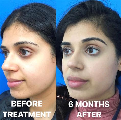 Teardrop Implants Before And After - Pinterest