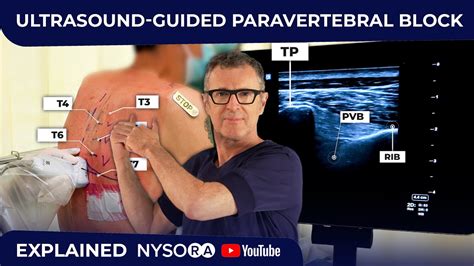 Tecnica del blocco paravertebrale toracico a ultrasuoni. - Kenwood ts 480 in depth manual.