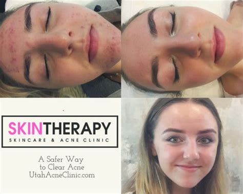 Teen Acne Treatment in Salt Lake City, Utah Skintherapy Skincare