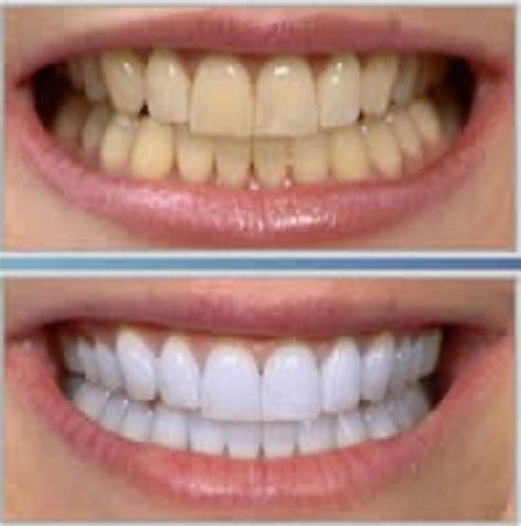 Teeth Whitening Materials Flashcards Quizlet