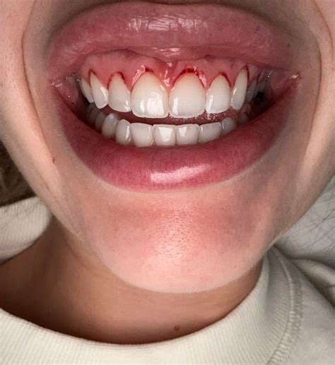 Teeth becoming more and more transparent.... : r/askdentists