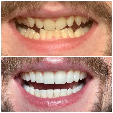 Teeth whitening reddit. The whitening isn't anything dramatic (like from yellow to pearly white) but certainly noticeable, and personally I don't want my teeth to look synthetically Hollywood white anyway! Plus, whitening strips mess with your teeth sensitivity, or at least they did in my experience. I suggest definitely giving it a try! 