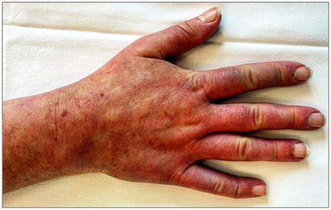 Telangiectases in Systemic Sclerosis Dermatology - JAMA