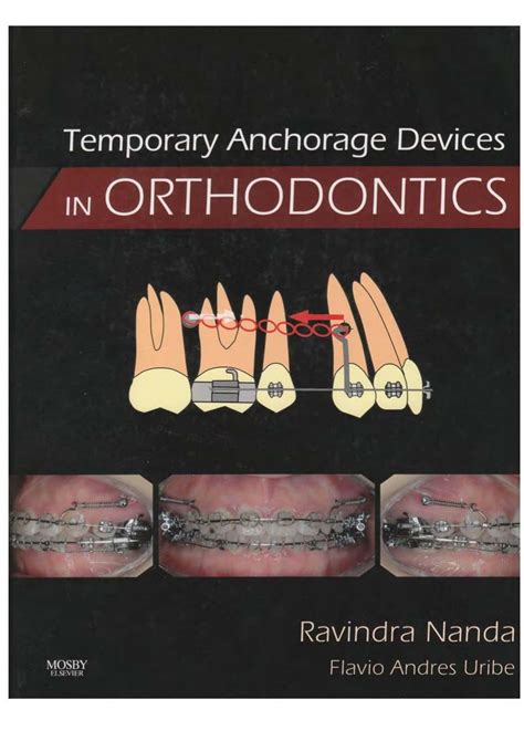 Read Online Temporary Anchorage Devices In Orthodontics Ebook By Ravindra Nanda