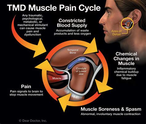 Temporomandibular joint dysfunction - symptoms, treatment and …