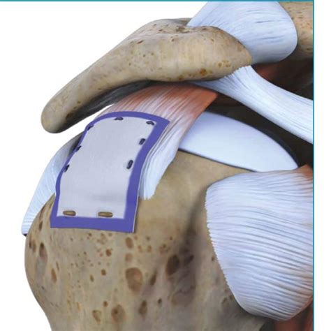 Tendon graft substitutes-rotator cuff patches - PubMed