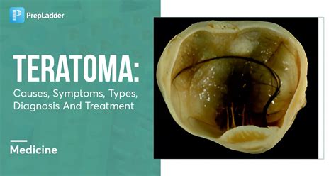 Teratoma Types symptoms and causes