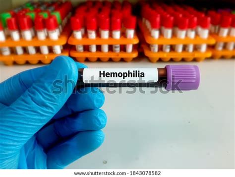 Test Tube with Blood Sample for Hemophilia Test Stock Image Image of