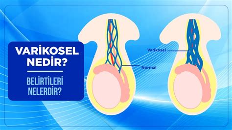 Testis varisi