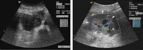 Tests For Neuroblastoma Neuroblastoma Ultrasound