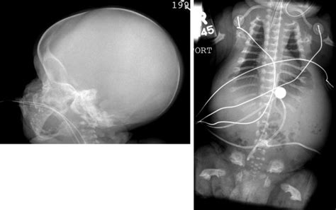 Thanatophoric Dysplasia - GeneReviews® - NCBI Bookshelf