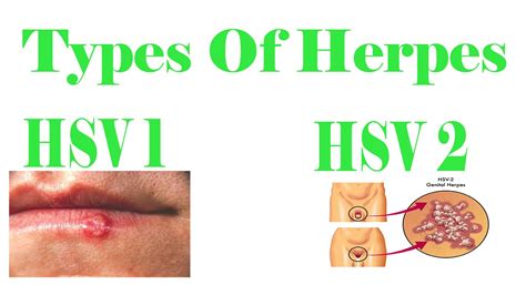 The 2 types of herpes: HSV-1 & HSV-2 Herpes Opportunity