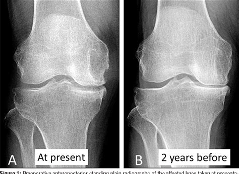 The Articular Intraosseous Cyst in Osteoarthritis: Subchondral Cysts ...