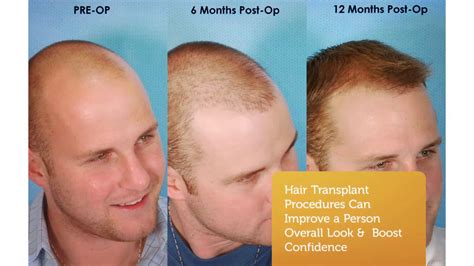 The Best Hair Transplant Dallas [ 2024 ]