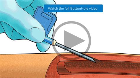 The Buttonhole Technique for AVF Cannulation - Medical …