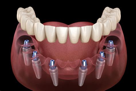 The Cost of Full Mouth Dental Implants with Insurance