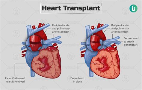 The Demand For A Heart Transplant Would Be Considered Price