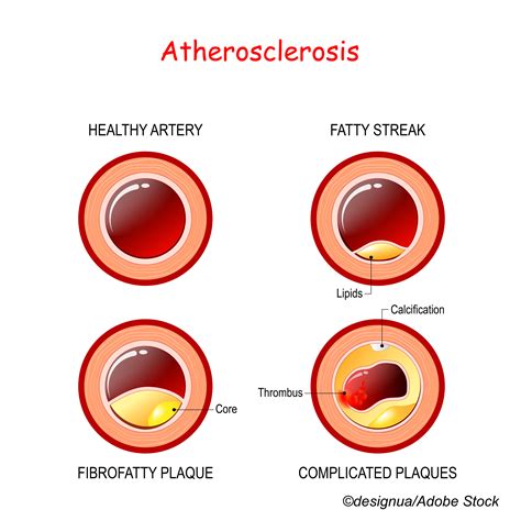 The Diagnostic Value of CAC Score Varies With Age