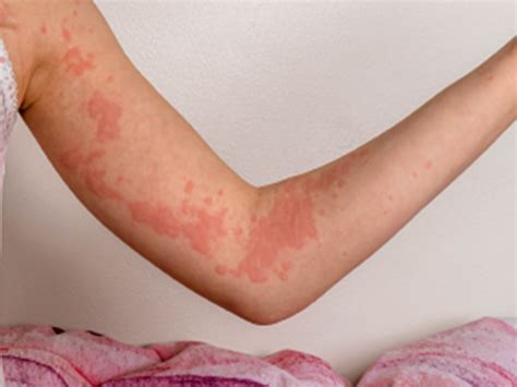 The Diagnostic Workup in Chronic Spontaneous Urticaria