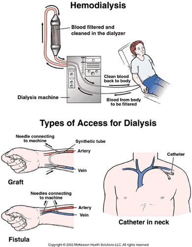 The Different Types of Vascular Access for Dialysis - Verywell Health