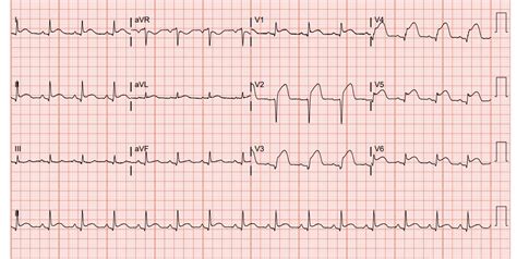 The ECG in Acute Myocardial Infarction - CHEST