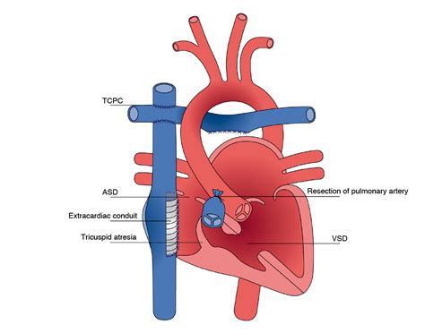 The Fontan Procedure Canadian Fontan