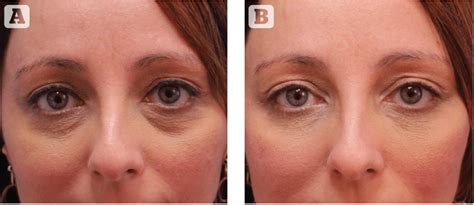 The G-Point Lift for InfraOrbital Rejuvenation PRIME Journal