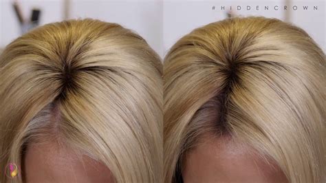 The Hidden Crown Hair Topper: A Natural-Looking Solution for Hair Loss